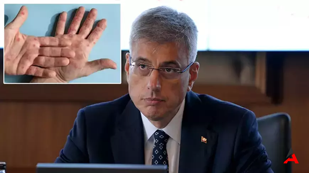 Maymun Çiçeği Virüsü Türkiye'de Var mı? Bakan Memişoğlu Açıkladı