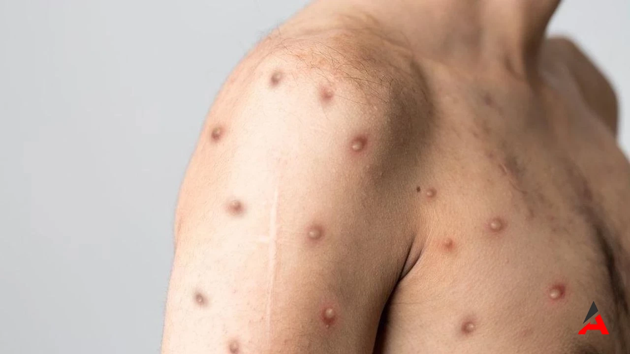 Mpox (Maymun Çiçeği) Virüsü Nedir?